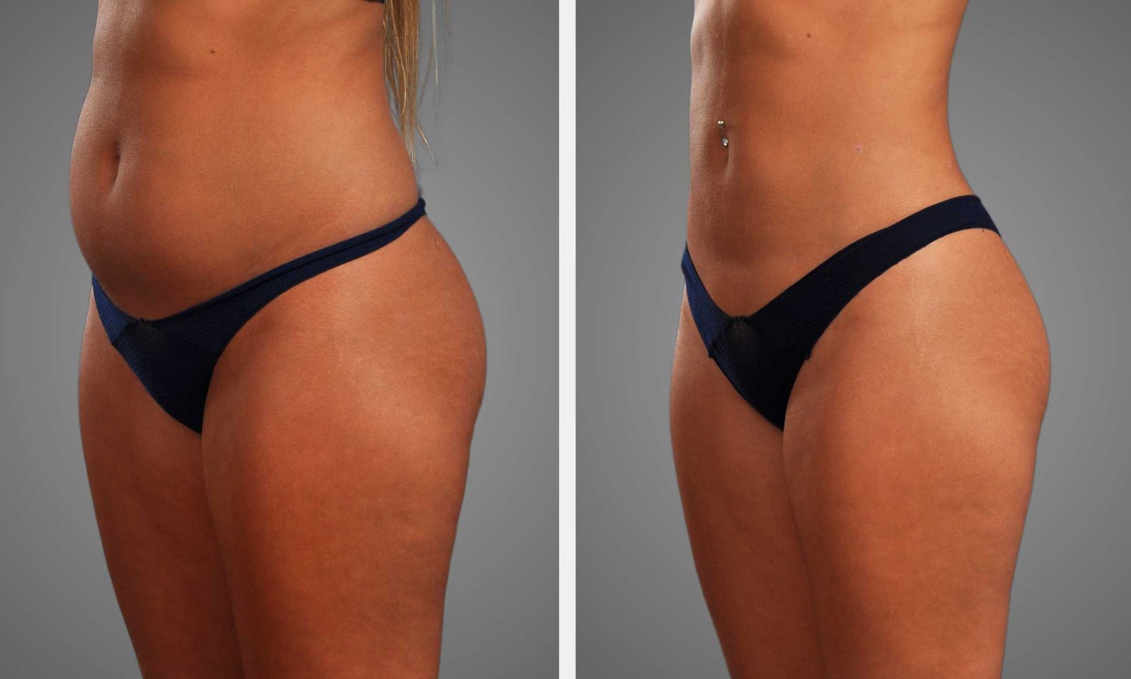 360 liposuction