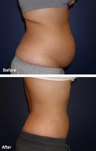 Endolift body