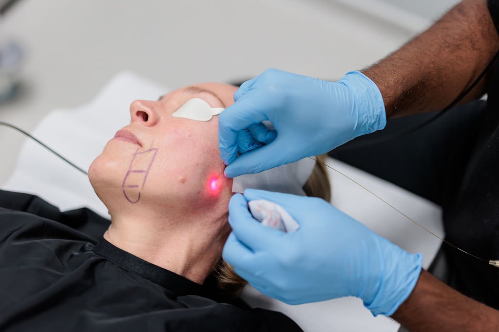 Endolift