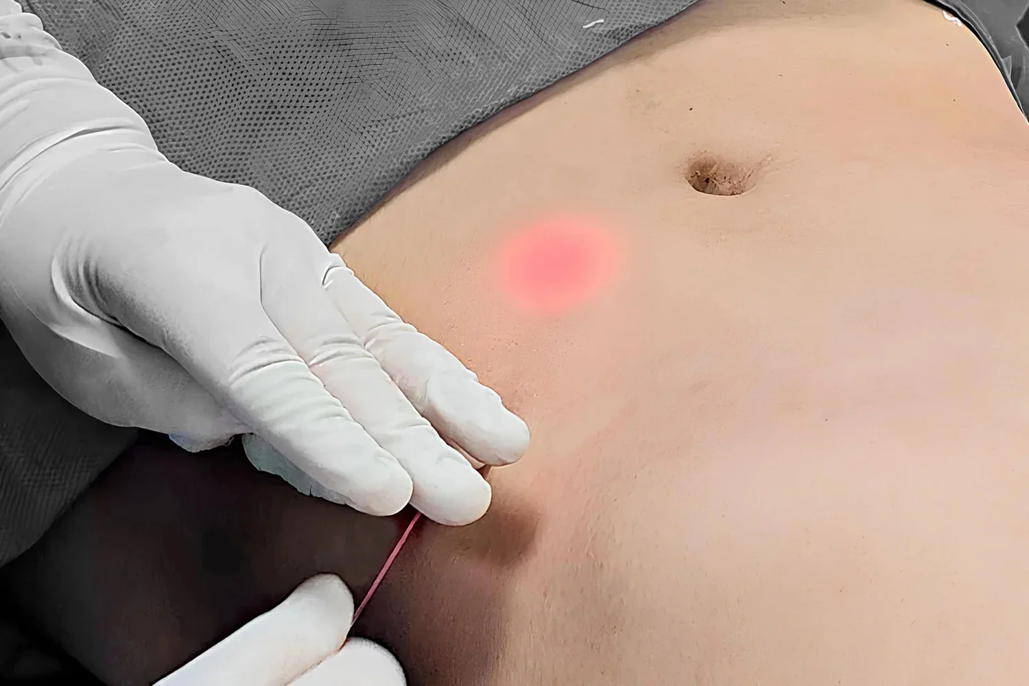 Endolift
