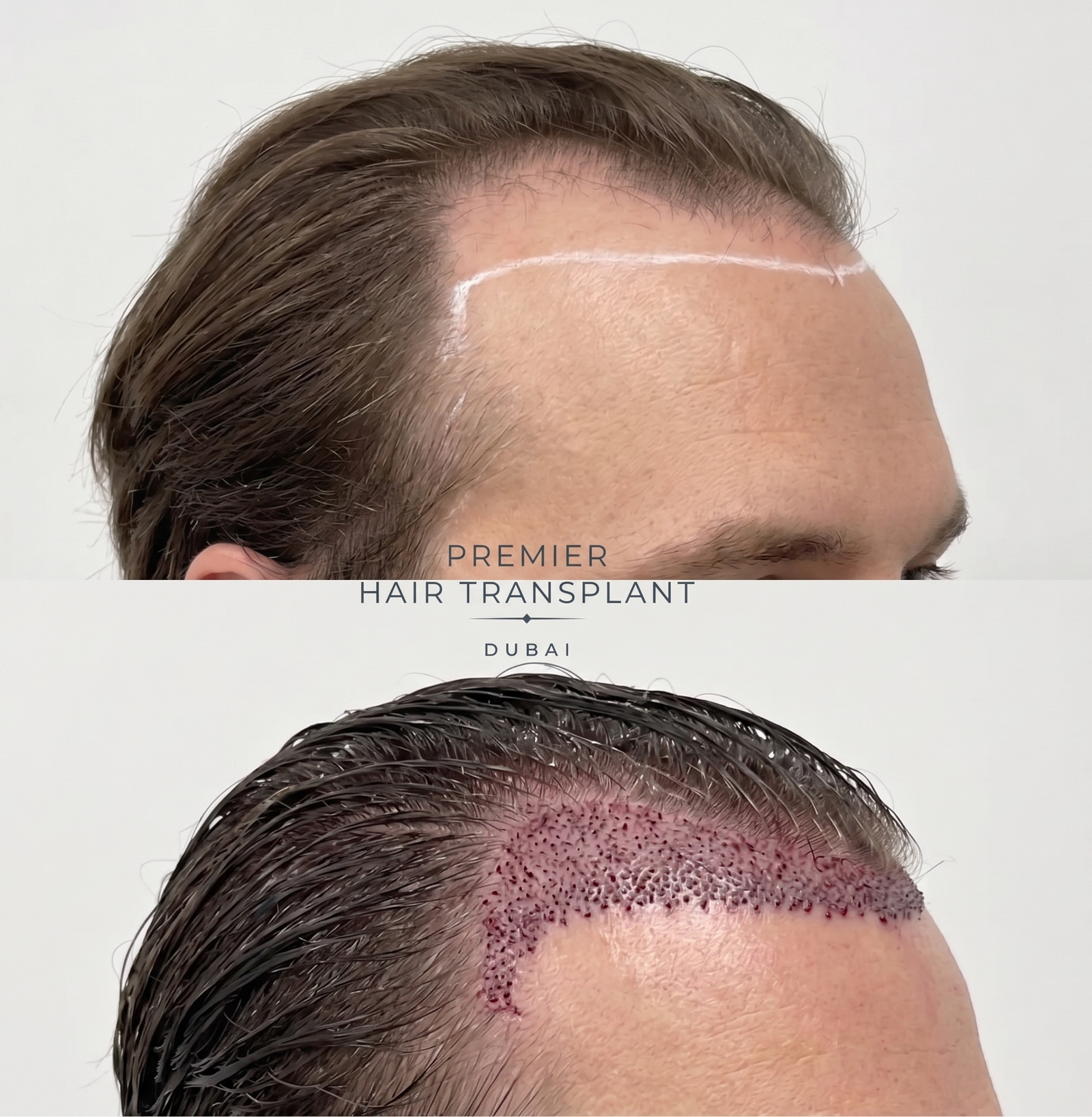 Hair Transplant