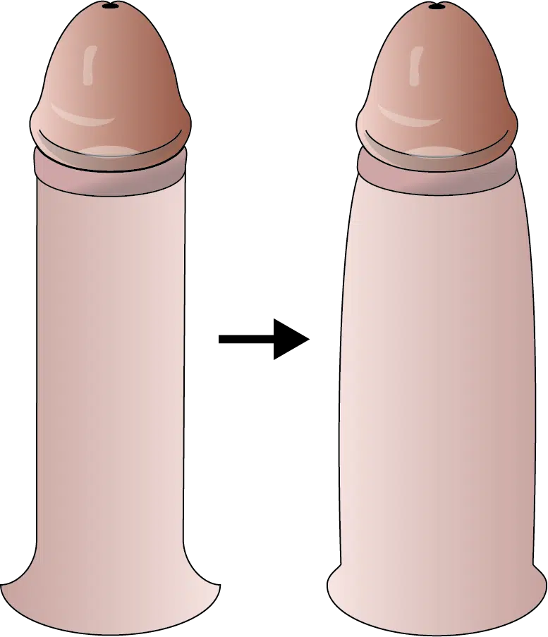 Penile Filler