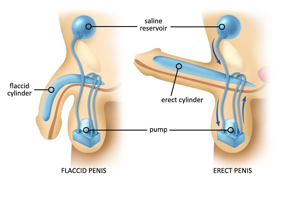 PRP Erectile Dysfunction