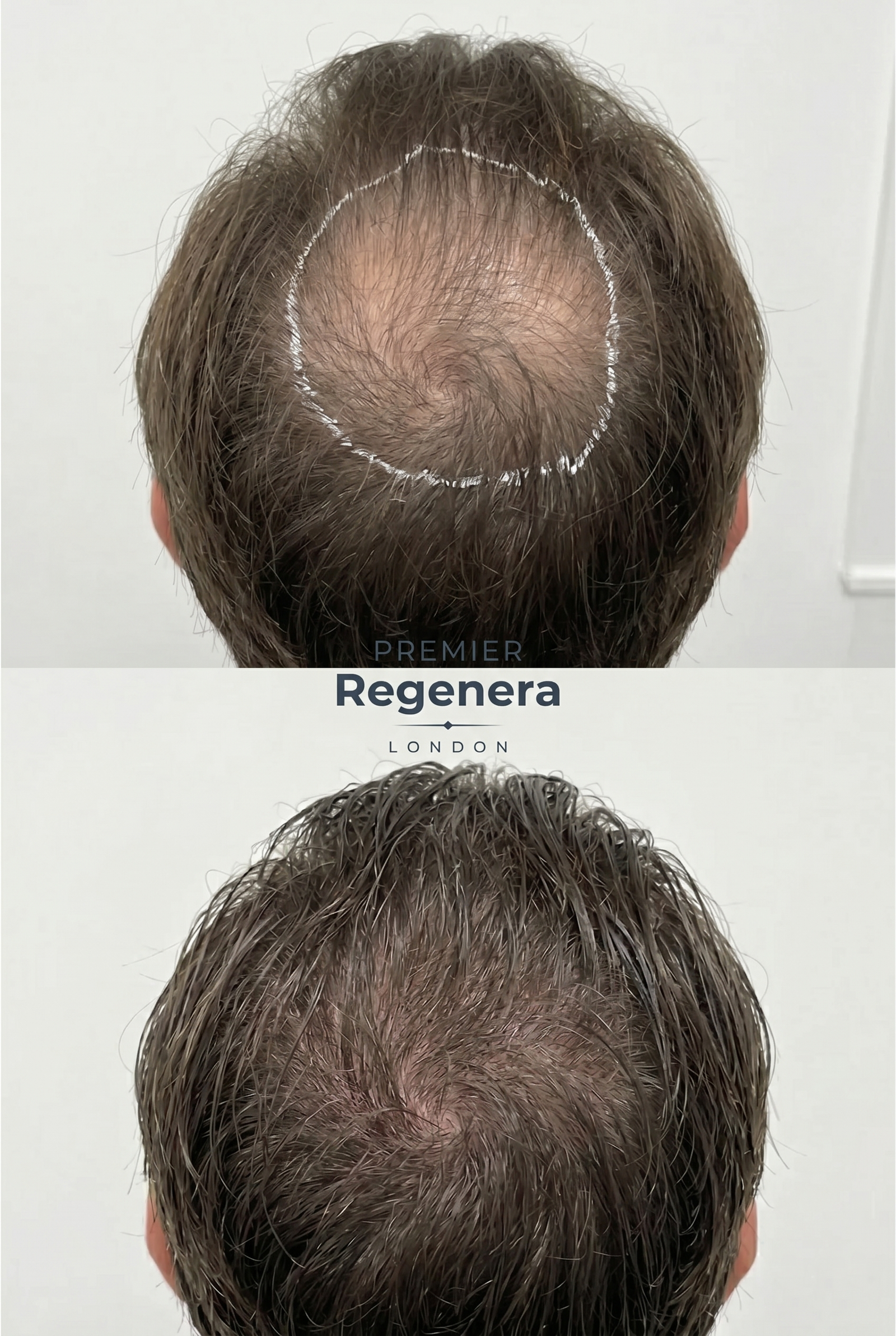 Regenera
