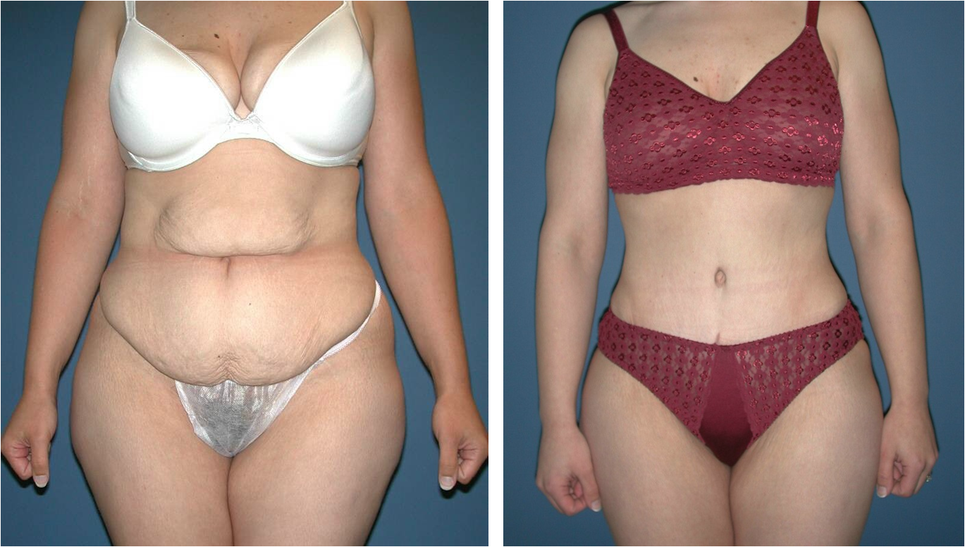 Tummy Tuck