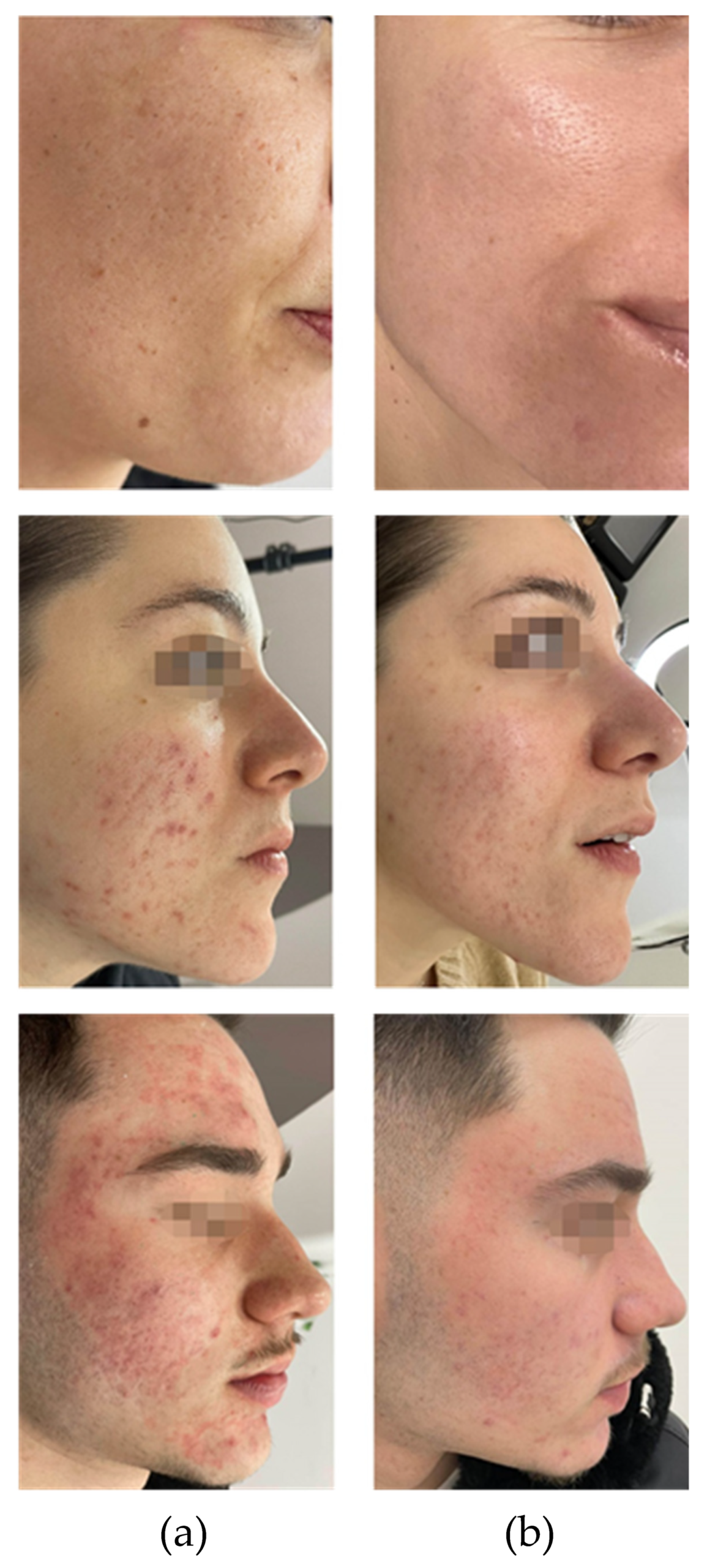 fractional laser