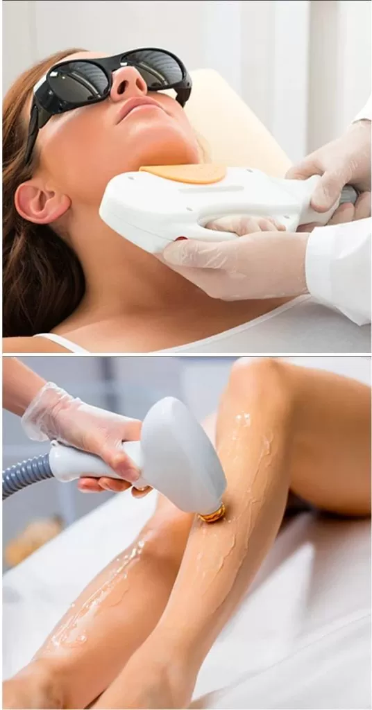 laser-hair-removal