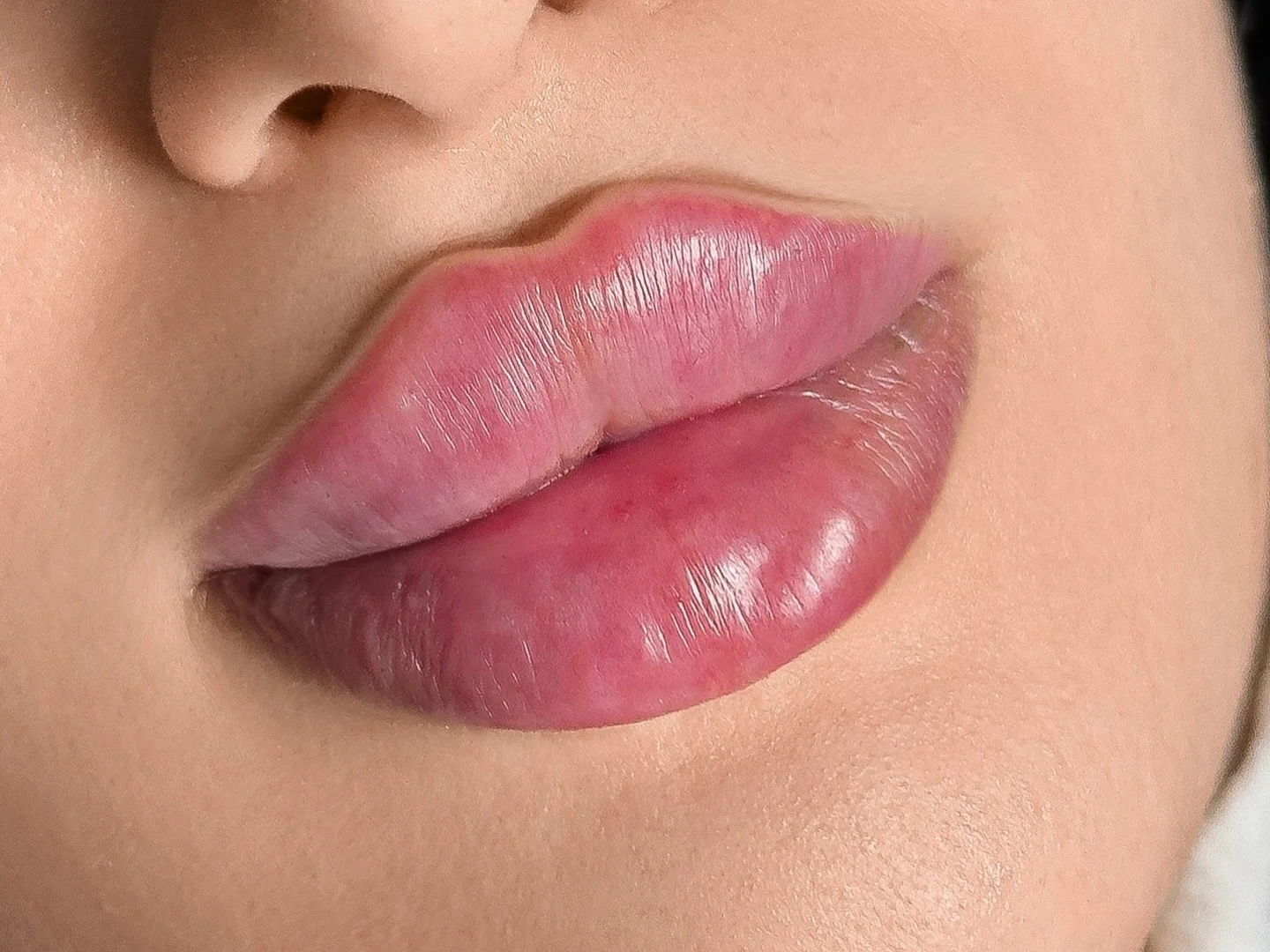 Lip Filler - Everyoung