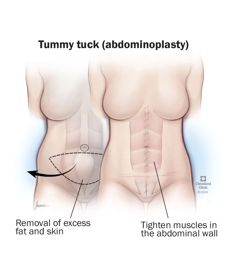 tummy-tuck