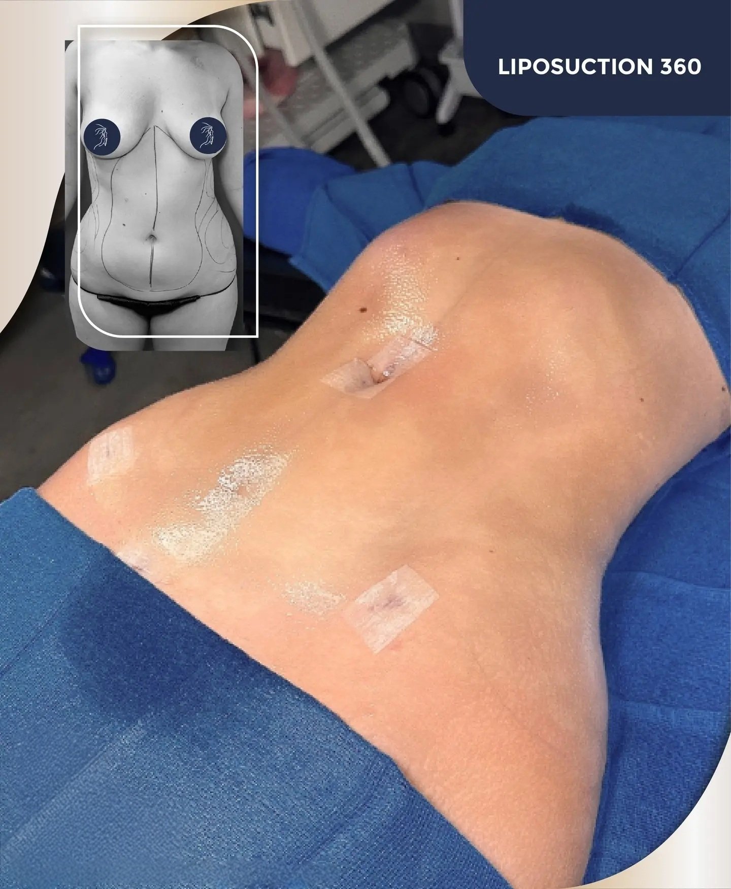 360 liposuction