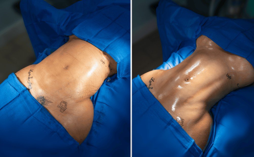 360 liposuction
