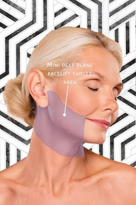 Mini Face Lift